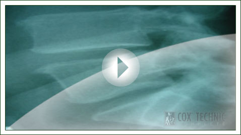 Retrolisthesis Video